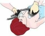 defibrillazione_attacco_cardiaco_improvviso